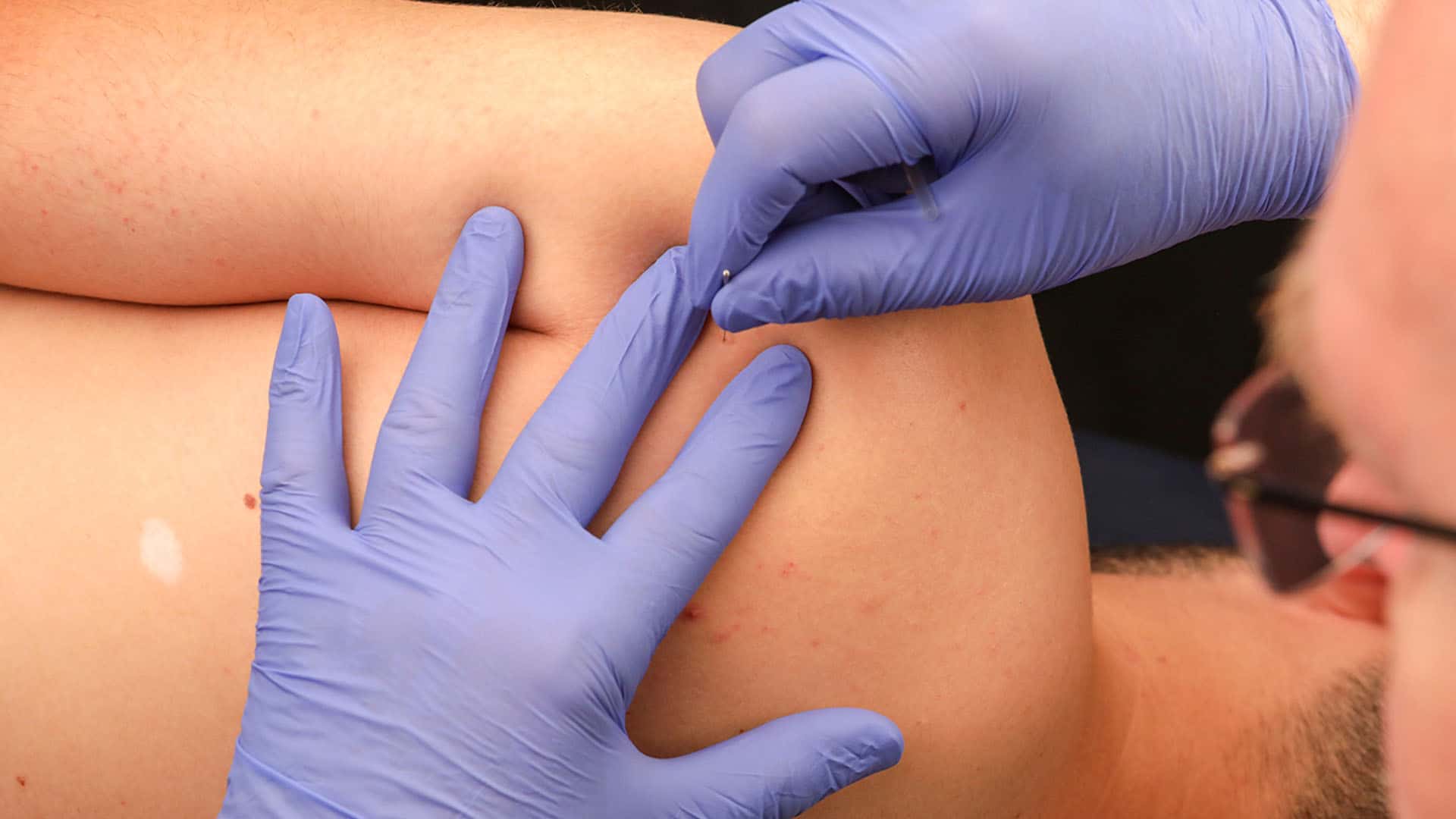 International Dry Needling